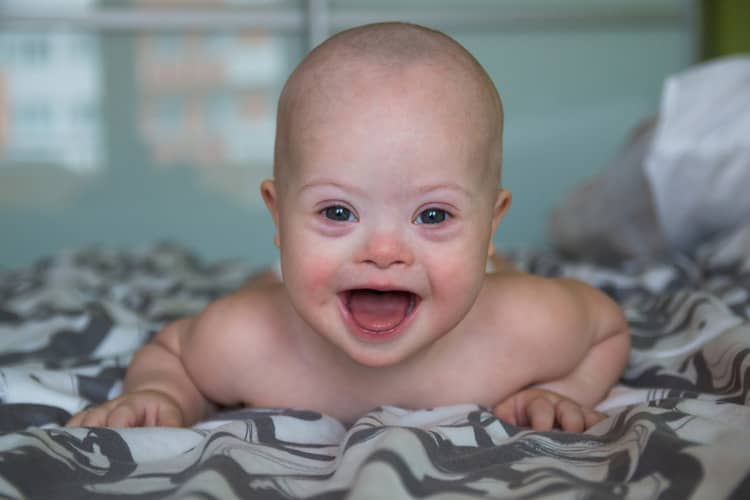 Down syndrome and its symptoms