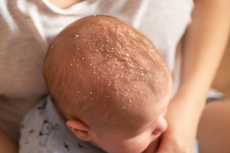 What is cradle cap?