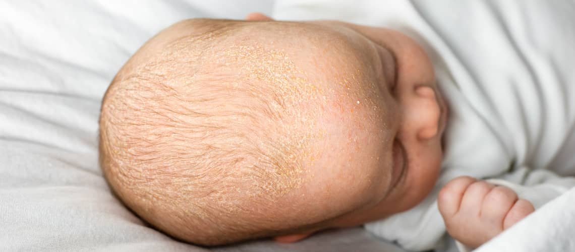 Cradle cap