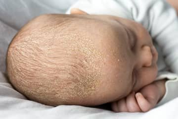 Cradle cap