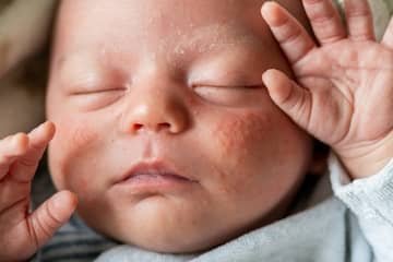 Newborn acne
