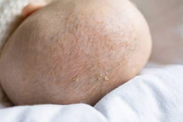 What Shampoo for Cradle Cap?