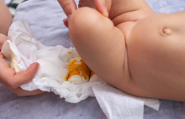 Yellow stool in a newborn