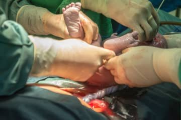 Cesarean section under general or spinal anesthesia. In which week is it done and what are the experiences