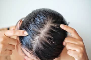 Hair loss after childbirth