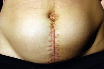 When will my stitches fall out after giving birth?