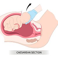 Caesarean section / birth