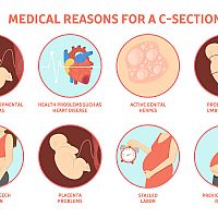 Medical reasons for a C-Section