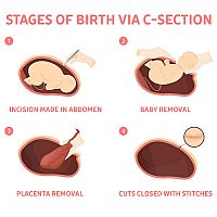 Stages of birth via C-Section