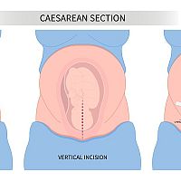 Caesarean section