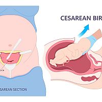 Cesarean birth