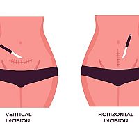 Vertical and horizontal incision
